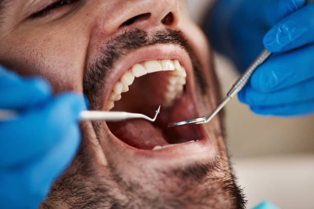 Best Emergency Tooth Extraction in Millington, NJ